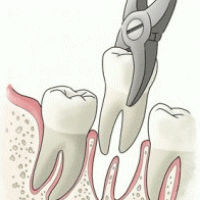 regular extraction
